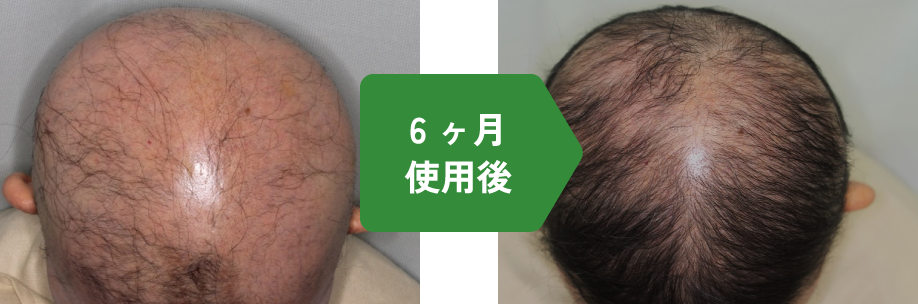 6ヶ月使用後イメージ