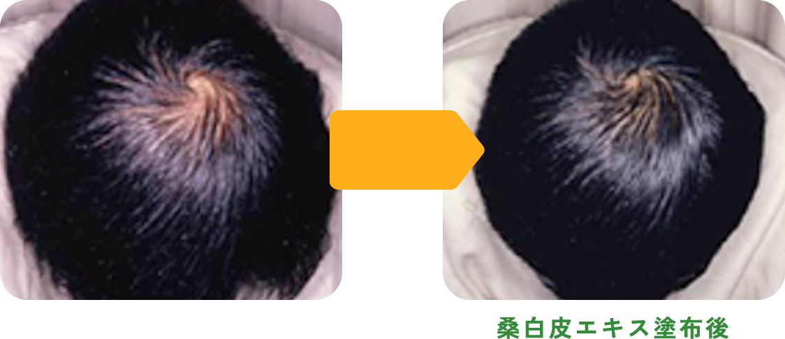 桑白皮エキスの育毛作用【男性】
