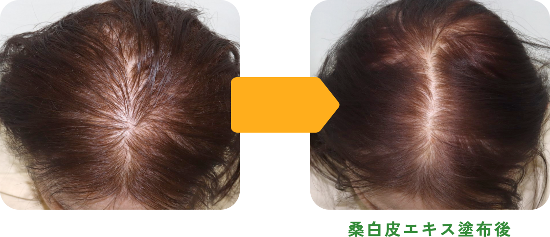 桑白皮エキスの育毛作用【女性】