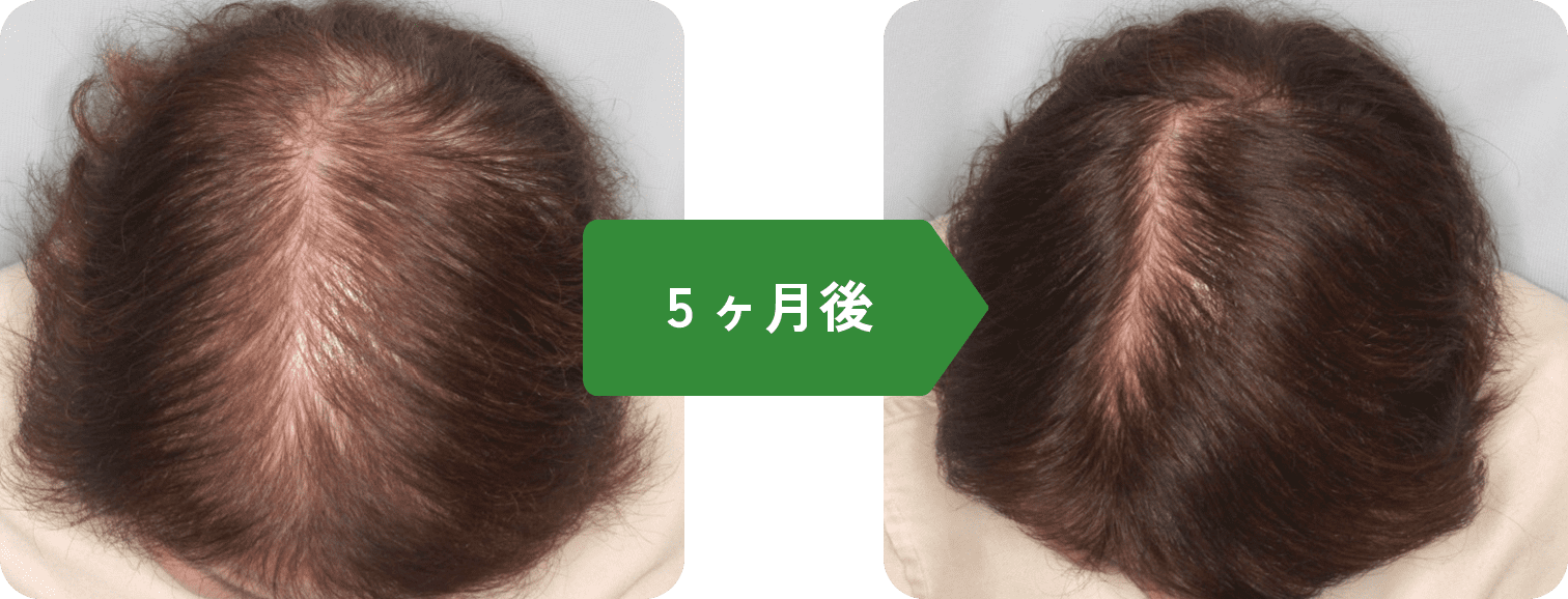 65歳女性が使用した効果　5ヶ月後イメージ